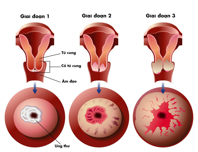 Ảnh 1 của Cervical Dysplasia